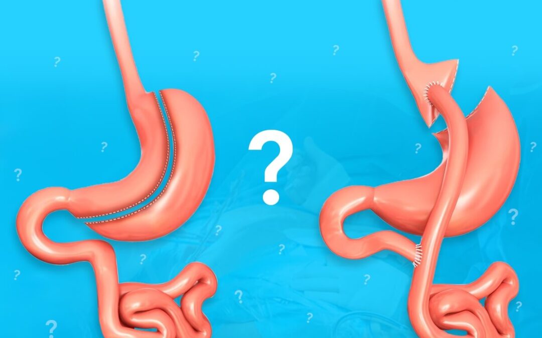 Gastrik bypass nasıl olur? neden yapılır?